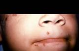 Cold Sore - Oral Herpes. An outbreak of herpes sores on a child's face ...