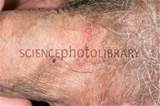 Shingles lesions on the penis