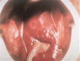 Female Cervix with Gonorrhea