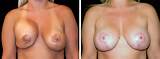 Breast Implant Malposition Before and After