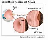 Photos related to Wet Amd