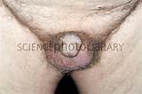 Shrunken penis in prostate cancer patient