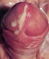 gonorrhea infection dick pus discharge -