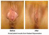 The photos show vaginal rejuvenation combined with labiaplasty.