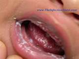 causes of oral yeast infection