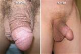 penile-reconstruction-surgery1.jpg