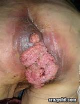 of all infected with genital warts have other stds already