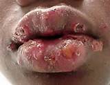 herpes simplex virus hsv 1 lip blisters