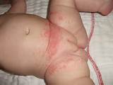 Harper's rash before treatment.