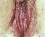 Bleeding vagina yeast infection