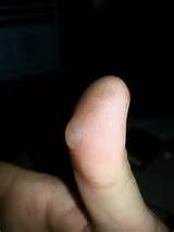 Its been like 10 years since i have had blisters that bad. I don't ...