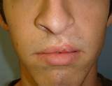 Before and After - Cleft Lip and Palates