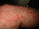 Have The Best Poison Ivy Rash, Poison Oak Bumps, Sumac Puss, and Bug ...