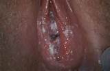 CANDIDIASIS VAGINAL