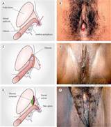 Different Stages of Female Circumcision in Photos | Best Gore