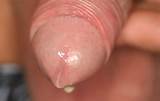 the clap gonorrhea infection showing dripping penile juice -