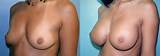 ... Implants (Silicone 450cc) Post-Pregnancy > Large Breast Implants