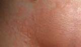 ... area with redness and blisters minutes after fourth laser hair