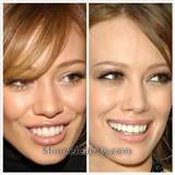 Hilary Duff Plastic Surgery â€“ dental work/cosmetic dentistry
