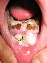 Description Mouth cancer bionerd.jpg
