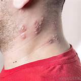 people with mild chickenpox are at risk for shingles when older