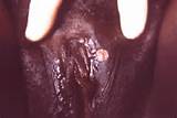 Syphilis aroun d the vagina Secondary syphilis around the vagina and ...
