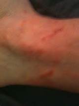 Spirit And Consequences: Day 100 Afternoon - Updated Rash Pics: I ...