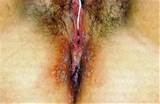female herpes simplex virus hsv 2 around vagina