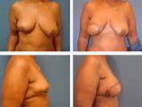 Breast Reconstruction Pioneer Valley Plastic Surgery Springfield