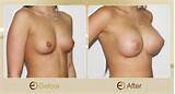 Breast Implants â€“ Augmentation & Enlargement Procedures