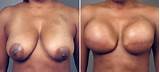 Reconstructive Plastic Surgery Virginia Nude and Porn Pictures