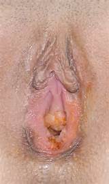 Clitoris Amputation