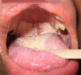 Gonorrhea Mouth Infection Causes Symptoms Treatment Pictures ...