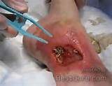 Maggot Therapy Applied to Rotten Foot | Best Gore