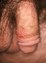 OTHER DISEASES that can be mistaken with herpes PICTURES
