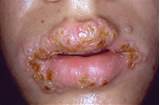 Gonorrhea Mouth