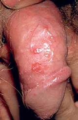 male herpes simplex virus 2 on