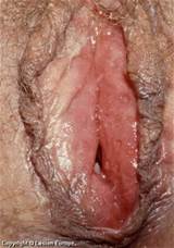 Close Up Genital Herpes Blisters In Vagina