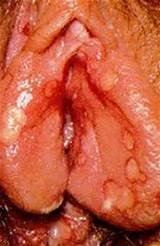 female herpes simplex virus hsv 2 on vagina