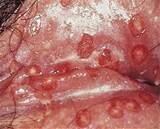 female herpes simplex virus 2 on pussy