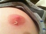 Felt a bump in my nipple and squeezed. Here's the result. ( i.imgur ...