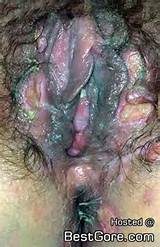 Blue Waffle Infection Picture
