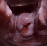 Age 26 â€“ Torn Cervix